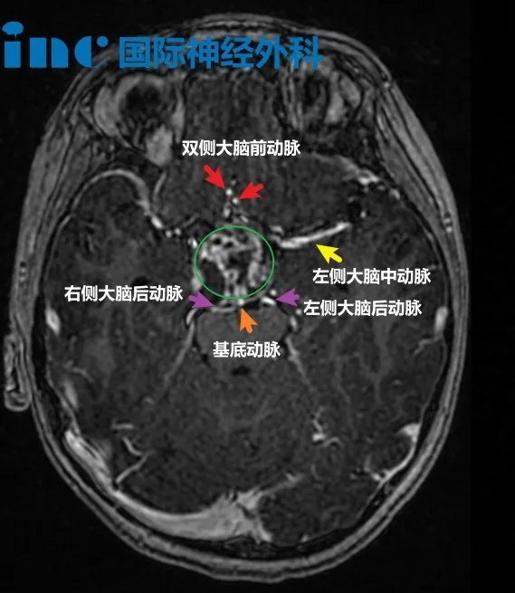 7歲男孩-鞍上區(qū)囊實(shí)性占位疑似顱咽管瘤。一次摔倒，竟然“摔”出腦腫瘤