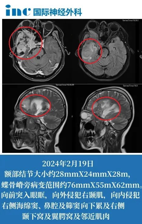 42歲女性-右側(cè)顳部、蝶骨嵴旁腦膜瘤復(fù)發(fā)