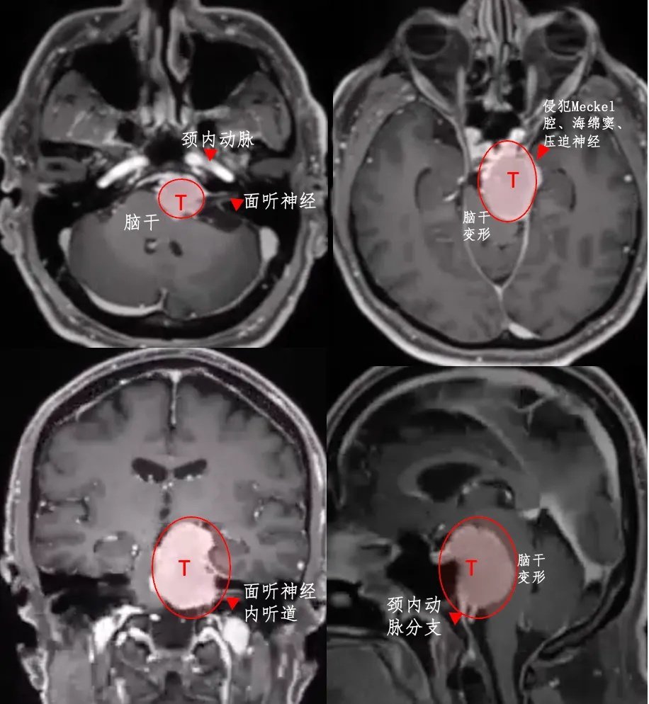 腫瘤位置深、體積大，已經(jīng)壓迫腦干