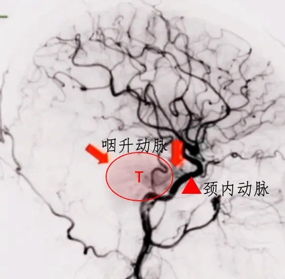 腫瘤被血管包繞，主要是咽升動(dòng)脈和頸內(nèi)動(dòng)脈硬腦膜分支，術(shù)中易損傷出血