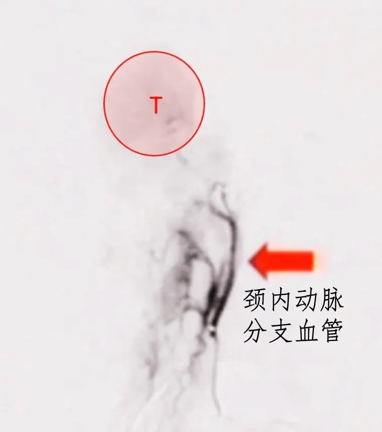 腫瘤被血管包繞，主要是咽升動(dòng)脈和頸內(nèi)動(dòng)脈硬腦膜分支，術(shù)中易損傷出血