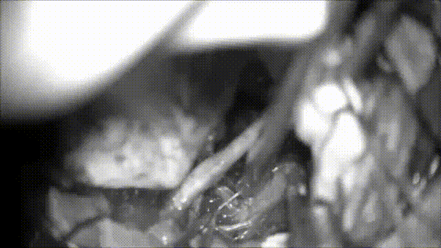 從病變處解剖穿支