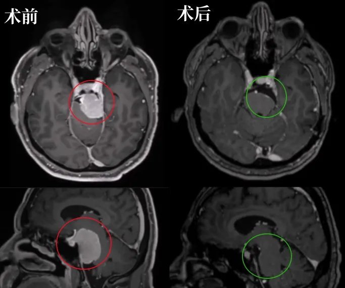 術(shù)后MRI顯示腫瘤幾乎完全切除，腦干受壓解除。