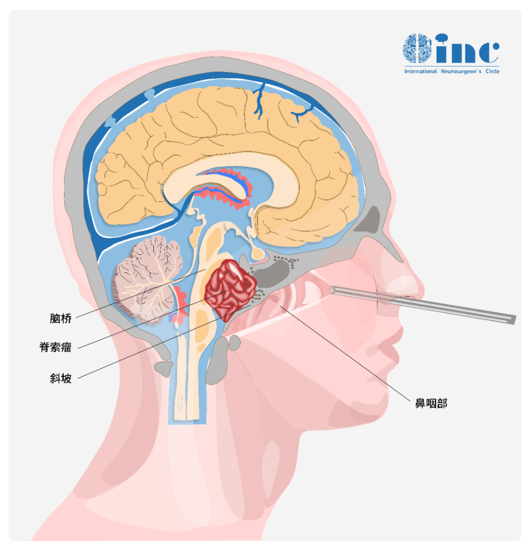 神經(jīng)內(nèi)鏡近年來逐漸成為顱底疾病，如鞍區(qū)腫瘤、如鞍區(qū)腫瘤、脊索瘤、環(huán)枕畸形、顱底凹陷等重要手術(shù)方式之一。
