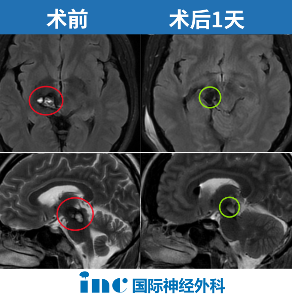 術(shù)前術(shù)后影像
