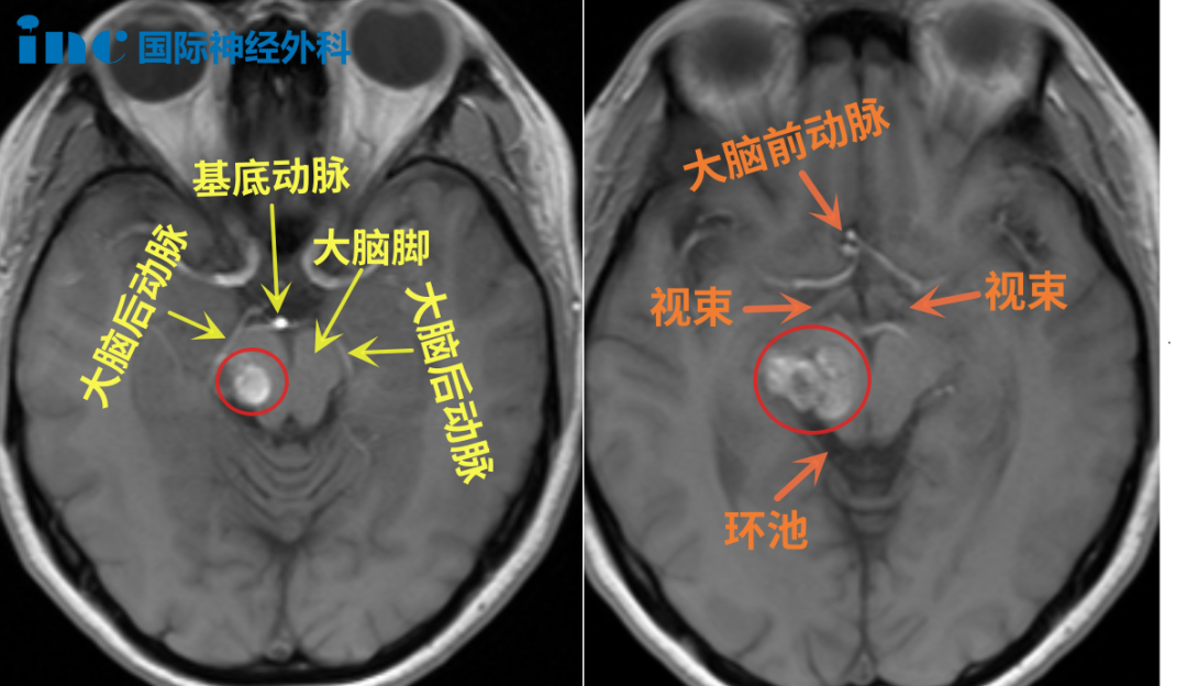病灶位于丘腦等重要功能區(qū)，周邊毗鄰大腦后動脈、基底動脈、大腦前動脈、視束等重要結(jié)構(gòu)