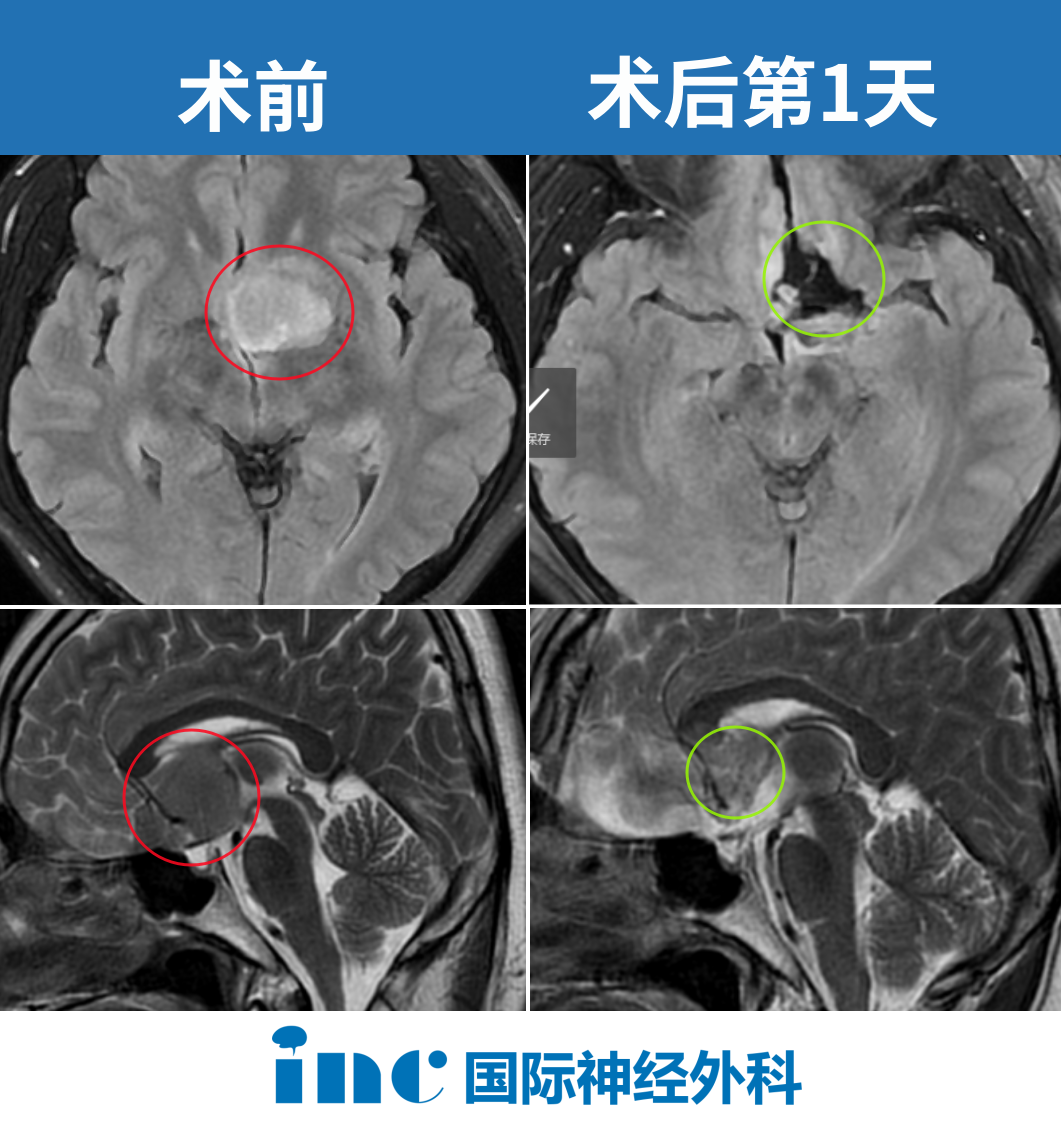 術后腫瘤切除達到預期，并且神經(jīng)功能保護得很好，無任何新發(fā)神經(jīng)功能損傷