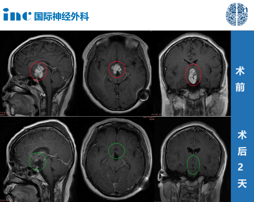 術前術后影像