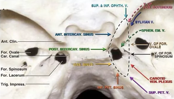 在這種情況下，腫瘤可以橫向延伸到海綿竇或向后延伸到后床突和巖斜區(qū)。