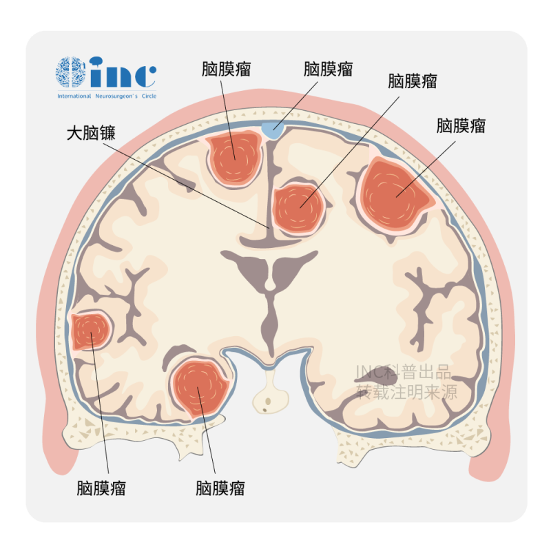 惡性腦膜瘤是怎么引起的?一般長在什么位置?