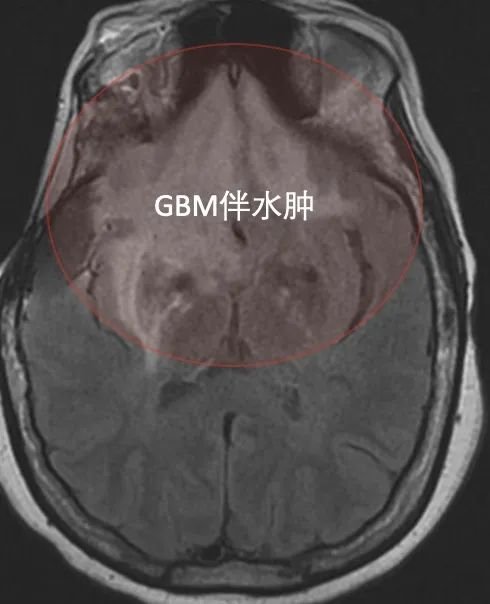 ▼高信號(hào)，顱內(nèi)多發(fā)病灶，雙側(cè)額葉廣泛病變,越過(guò)中線，累及胼胝體。