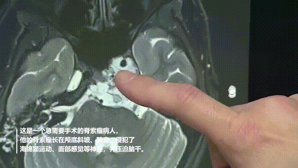 福教授在術(shù)前分析患者影像資料，指出腫瘤所在位置及周邊重要腦組織及結(jié)構(gòu)。
