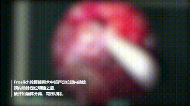 術(shù)中超聲定位頸內(nèi)動脈，頸內(nèi)動脈定位明確之后，便開始瘤體分離、減壓切除。而后，他開始切除基底動脈及腦干邊的腫瘤，并注意小心分離血管，注意保護(hù)腦干等關(guān)鍵結(jié)構(gòu)