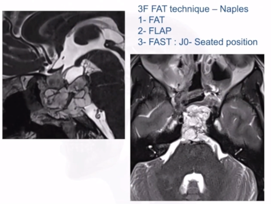 3F技術(shù)(Fat, Flap, Flash)