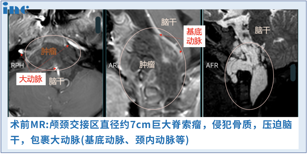 6歲男孩較大脊索瘤，單鼻孔8mm切口、不開顱成功手術(shù)