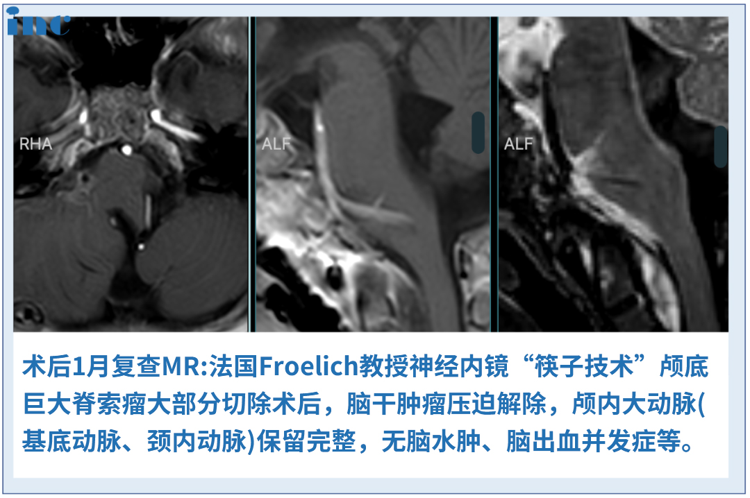 6歲男孩較大脊索瘤，單鼻孔8mm切口、不開顱成功手術(shù)
