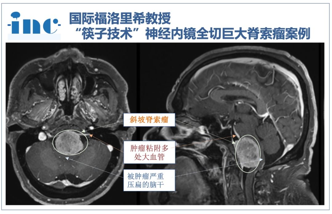 術(shù)前MRI：腫瘤由斜坡向后生長，突破顱底硬膜長至硬膜下，直接壓迫腦干腹側(cè)，較嚴(yán)重的地方腦干已被壓扁至原來的三分之一。