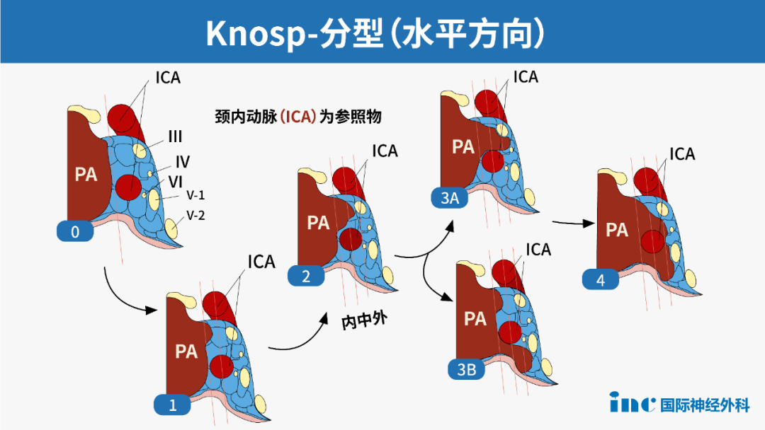 表1.垂體腺瘤改良Knosp分級(jí)
