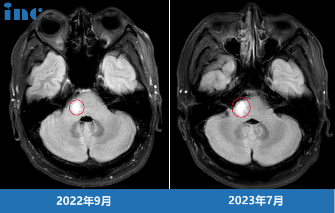 點擊韓先生術前影像，閱讀完整患者故事