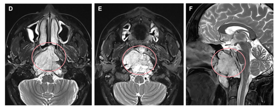 D、E術(shù)前軸向和F矢狀 t2加權(quán)MRI