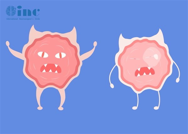 腦干海綿狀血管瘤二次出血癥狀明顯嗎?怎么檢查?