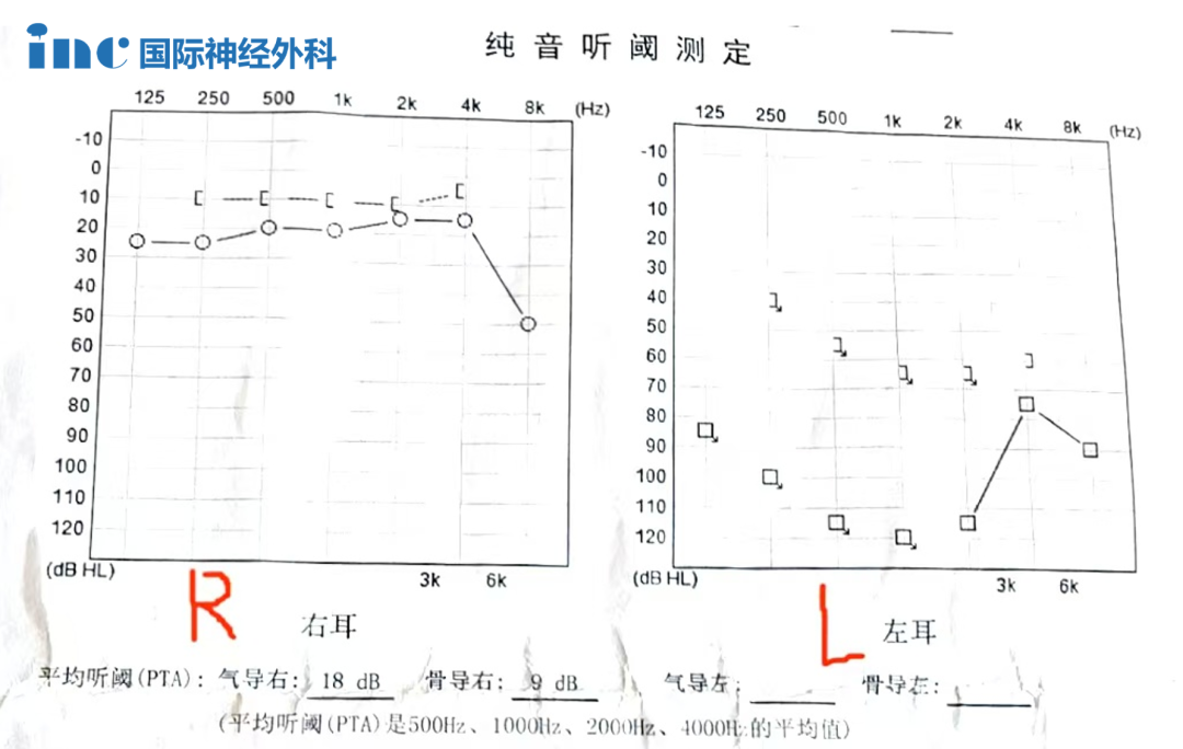 頸靜脈孔區(qū)腦膜瘤
