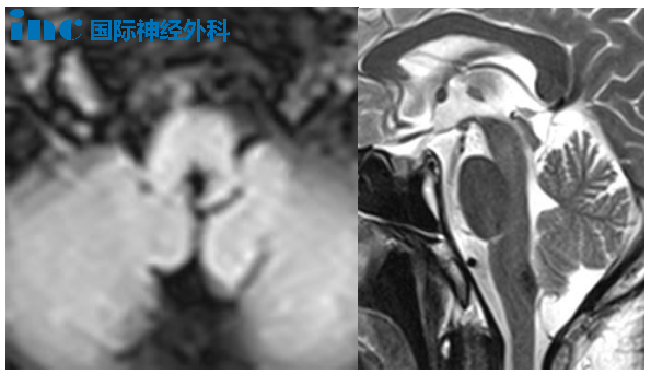 腦干-腦橋海綿狀血管瘤 53歲男性 蘇先生