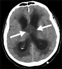 CT圖像顯示第三腦室內(nèi)的囊性腫瘤(箭頭)導(dǎo)致腦室系統(tǒng)明顯擴張。