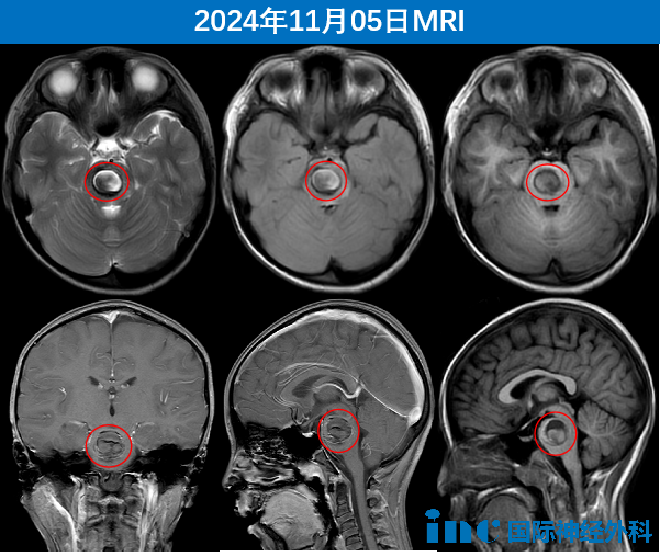 這“神”來之術  開顱術后當天竟未進ICU——兒童疑難<a href='/naoliu/' target='_blank'><u>腦瘤</u></a>示范手術順利進行！