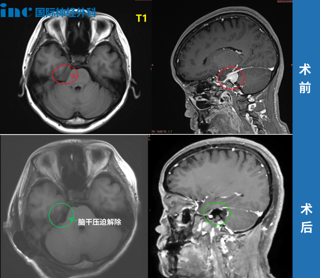 ▼術(shù)前術(shù)后MRI對比
