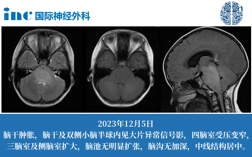 核磁共振掃描顯示，彌漫性腦干病變累及延髓、腦橋和中腦下部。第四腦室受到壓迫，導(dǎo)致幕上腦積水。