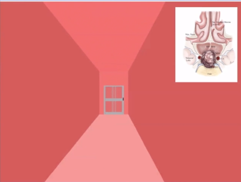 這是我經(jīng)常使用的一個概念性圖示，其中的“門”類似于蝶竇的前壁，是我們希望打開的目標(biāo)位置，以便進(jìn)入蝶竇腔內(nèi)。