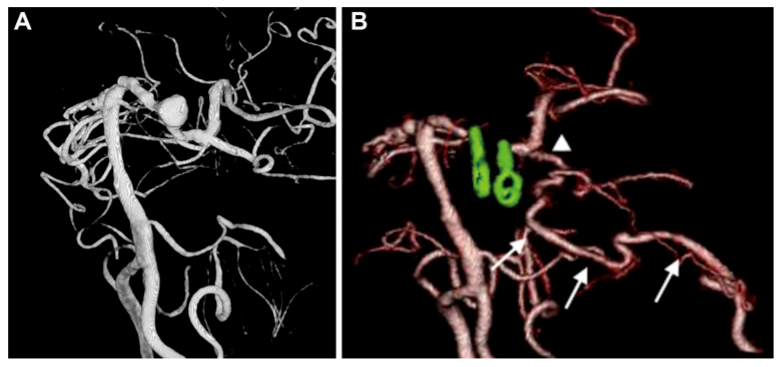 A：術(shù)前 3D-DSA 顯示位于左側(cè) P1-P2 交界處動脈瘤。B：術(shù)后3D CTA顯示左側(cè) PCA 區(qū)血管穿支(箭頭)和重建的PTA血管(箭頭)的血流通暢。
