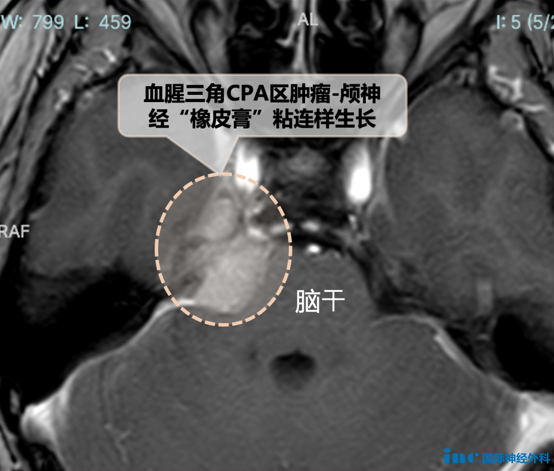 橋小腦角(CPA)區(qū)腦膜瘤
