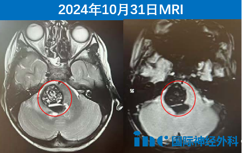 中腦-橋腦海綿狀血管瘤