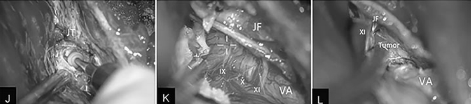 打開后顱窩硬腦膜后，磨除頸靜脈結(jié)節(jié)以獲得更大的手術(shù)通道，通過(guò)椎動(dòng)脈與后組顱神經(jīng)之間的通道切除頸靜脈孔周圍的腫瘤。