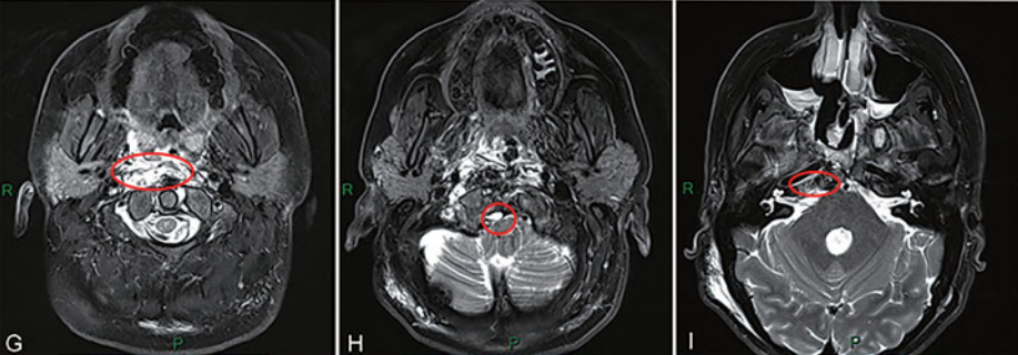 MRI T2加權(quán)成像顯示內(nèi)鏡輔助執(zhí)行的手術(shù)區(qū)域。在內(nèi)鏡輔助下，成功地切除了樞椎齒狀突(G中的紅色圓圈)、顱頸交界處(H中的紅色圓圈)和中斜坡區(qū)(I中的紅色圓圈)的腫瘤。
