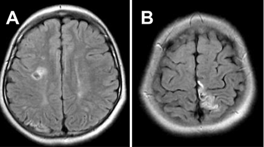 圖A&B：患者初次就診時(shí)進(jìn)行的 FLAIR MRI，顯示 MMD 引起的雙側(cè)腦梗死。