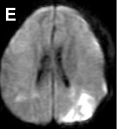 圖E：左側(cè)聯(lián)合搭橋手術(shù)后進(jìn)行的彌散加權(quán) MRI 顯示遠(yuǎn)離搭橋的區(qū)域發(fā)生意外腦梗死。