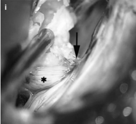 箭頭指向進(jìn)入頸靜脈孔的腫瘤部分(i)