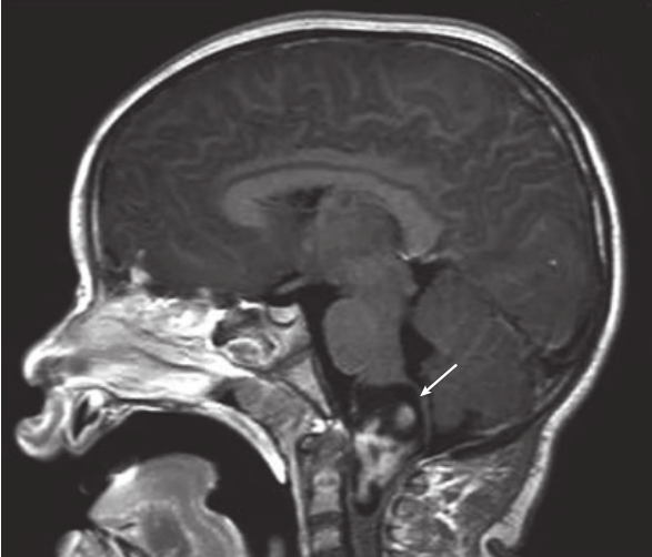 一名 6 歲女孩的矢狀位 MRI 顯示強化的延髓-頸髓交界處的病變(箭頭)。這個孩子最初表現(xiàn)為癲癇發(fā)作，但后來表現(xiàn)出進行性左側偏癱。