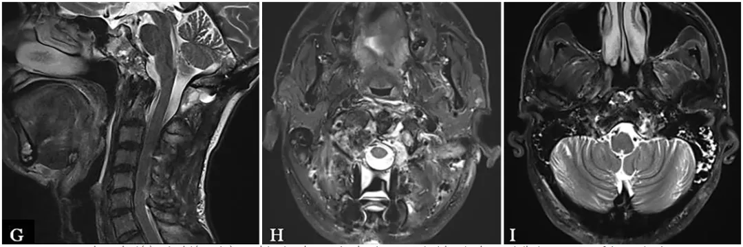 該患者術(shù)后 MRI，顯示近全切除(NTR)。