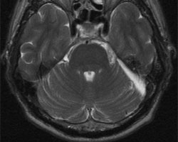 術(shù)后 MRI 圖像顯示腫瘤已完全切除。