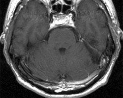 術(shù)后 MRI 圖像顯示腫瘤已完全切除。