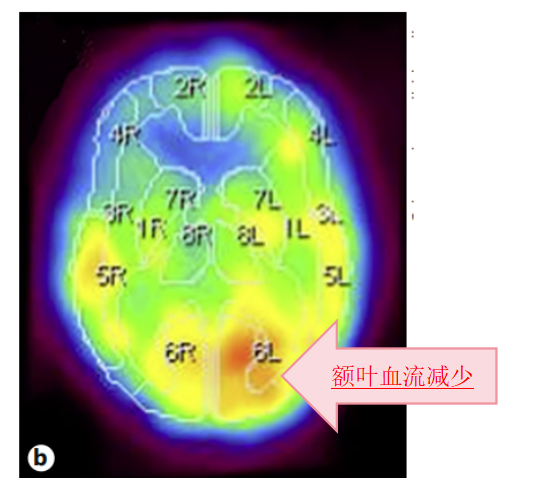 圖2：右側(cè)額葉明顯腦血流減少、代謝低，提示既往腦梗病史。
