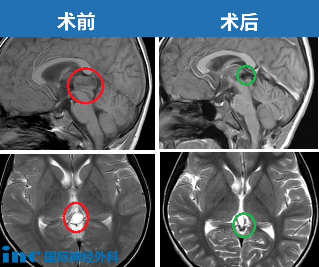 6歲男孩-松果體腫瘤