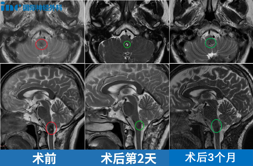 術(shù)前術(shù)后MRI影像