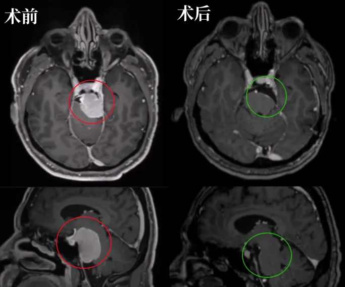 術(shù)前術(shù)后MRI影像