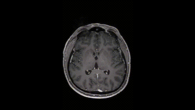 該患者2019年的磁共振成像(MRI)檢查結(jié)果
