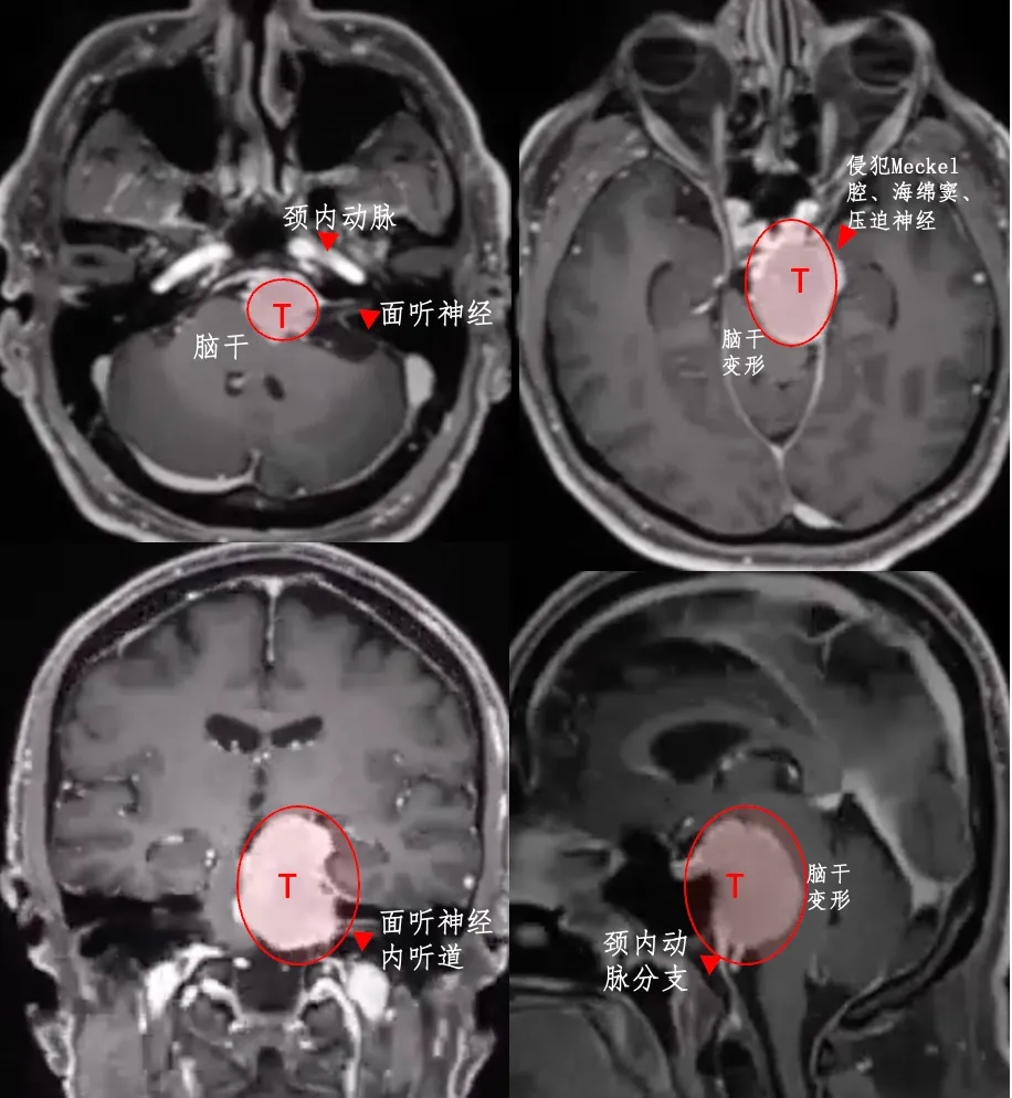 在侵襲前顱窩、中顱窩和后顱窩的情況下，巖斜區(qū)腦膜瘤的手術(shù)難度較大，